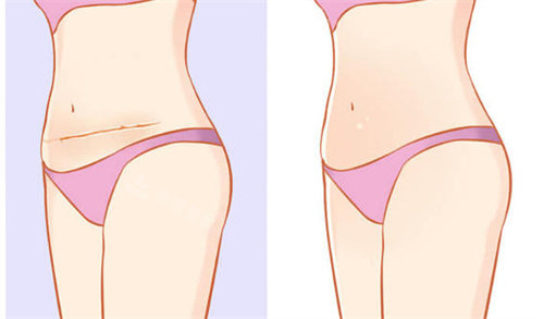 剖腹产疤痕修复前后对比