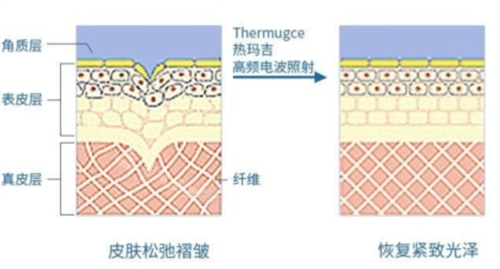 热玛吉作用在皮肤上皮下组织展示