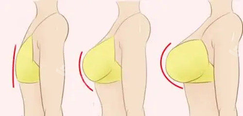 胸部整形卡通示意图