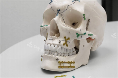 面部輪廓整形固定用鈦釘鈦板頭骨模型