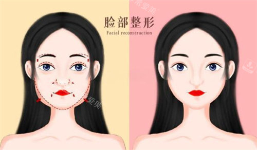 面部輪廓前后對比卡通圖