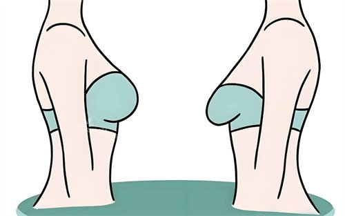 胸部下垂提升对比卡通图