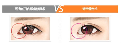 内眼角修复两种手术对比 内眼角修复两种手术对比