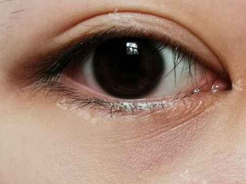 眼下细纹 眼下细纹