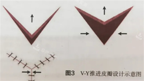 v-y成型法 v-y成型法