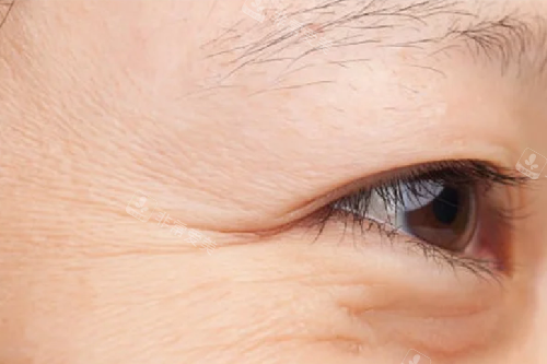 眼周细纹 眼周细纹