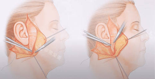 北京加减美v9手术原理深层错位固定