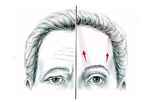 上眼皮提肌手术在韩国整形医院做的成效非常好！眼睛变大有神，连抬头纹都少了！