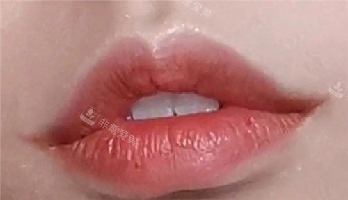 韩国唇部整形擅长的医院有哪些？珠儿丽、碧夏、WJ原辰三家主打唇整形高人气医院汇总！