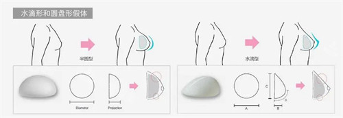 假体隆胸过程图 假体隆胸过程图