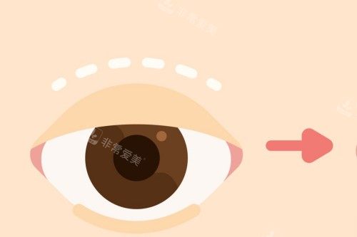 雙眼皮手術(shù)卡通對(duì)比