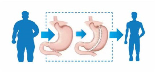 袖状胃切除手术优势卡通图