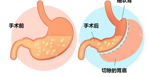 袖状胃切除手术前后对比卡通