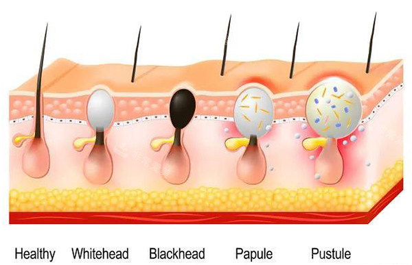 针清皮肤毛囊示意图
