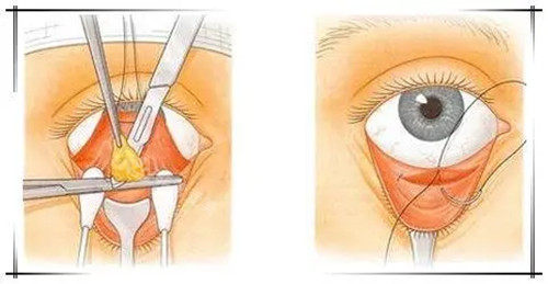 常州去眼袋哪个医院比较好点？分享三家眼袋领域技术比较出色的医院名单！