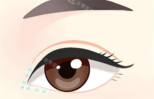 开眼角动画展示图片