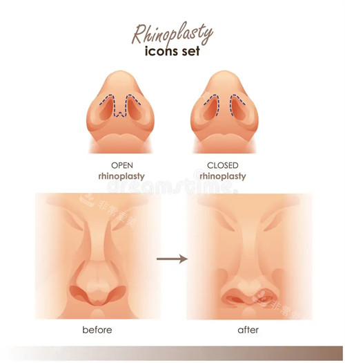 需要矫正的歪鼻