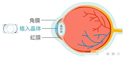 近视眼卡通图示