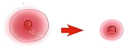 乳晕缩小对比图