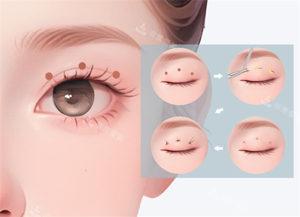 雙眼皮整形卡通圖片 雙眼皮整形卡通圖片