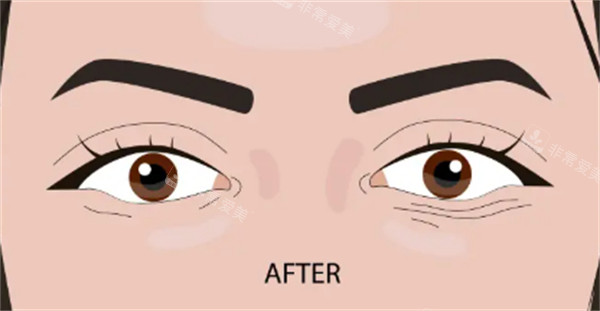 双眼皮手术后