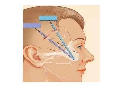 微拉美提升的部位