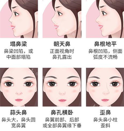 韩国鼻修复手术哪家好?Banana整形外科崔源哲院长修复术例真实自然！