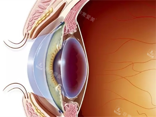 割眼角膜手术眼部侧面透视图