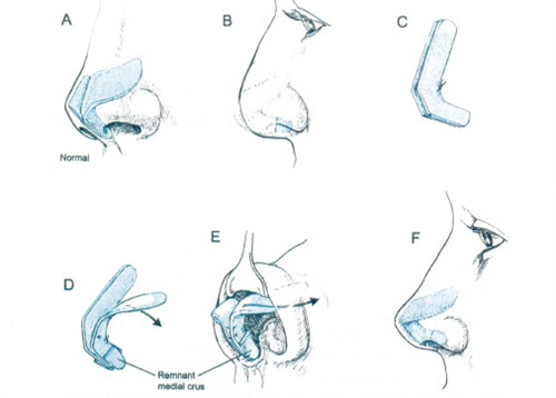 北京鼻综合做得好的十大医生排名，王旭东、李劲良、巫文云、牛勇敢风格全对比！