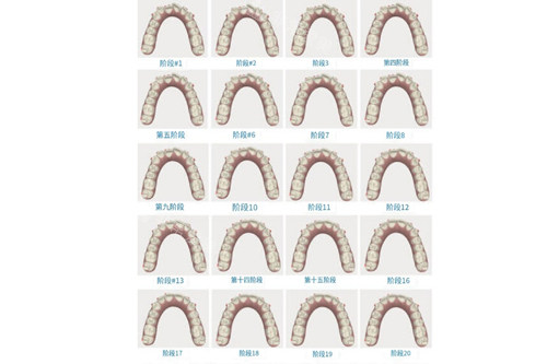 牙齿矫正变化图片