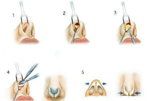隆鼻手术填充过程展示图