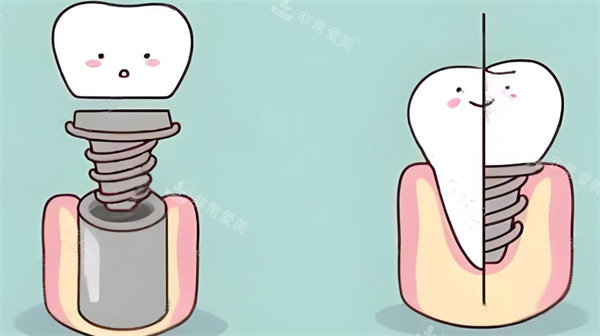 牙齿种植卡通图片