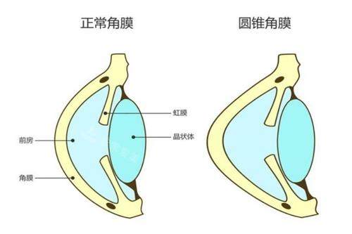 圆锥角膜和正常角膜的对比