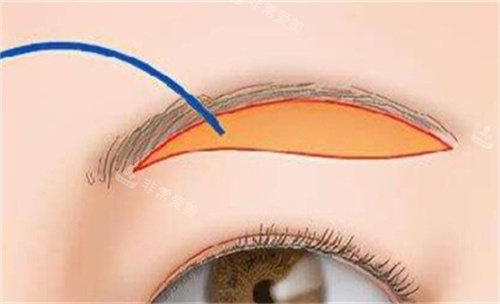 提眉手术的切口部位