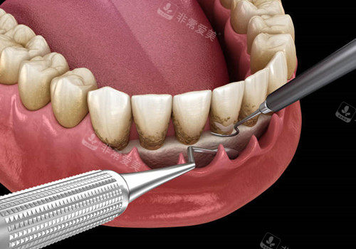 牙周刮治外部图