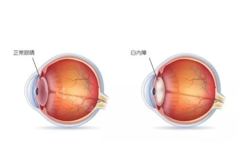 正常眼睛与白内障眼镜对比图