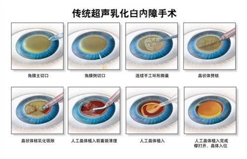 超声乳化白内障手术