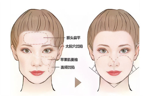 面部轮廓填充前后对比 面部轮廓填充前后对比