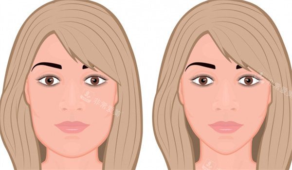 面部轮廓整形手术前后对比 面部轮廓整形手术前后对比