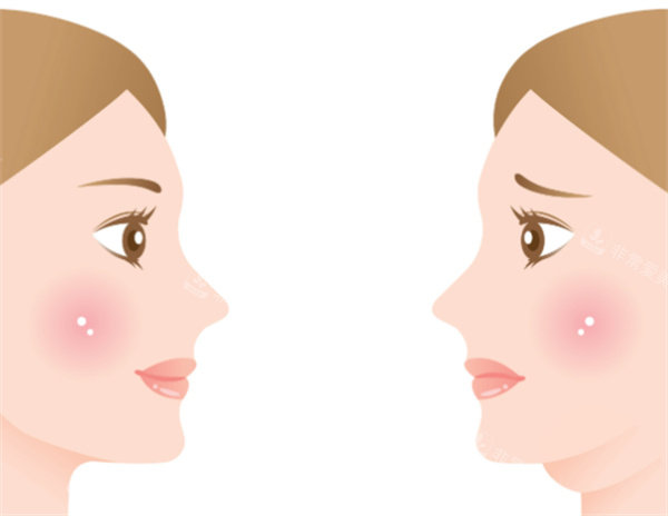 双下巴整形前后对比