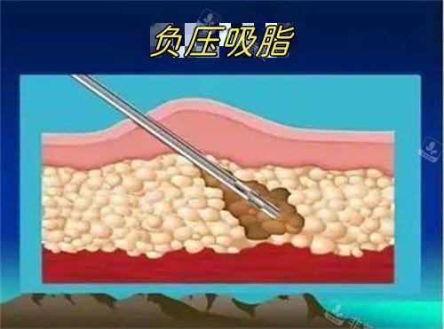 负压吸脂示意图