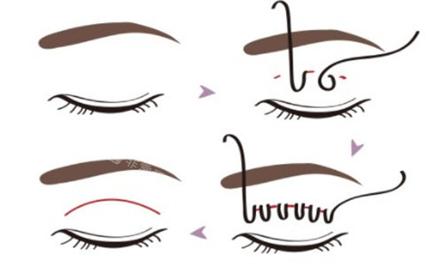 VLINE雙眼皮手術(shù) VLINE雙眼皮手術(shù)