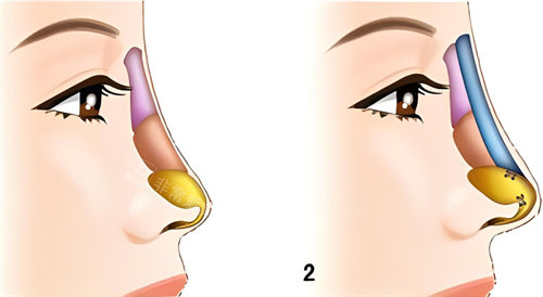 隆鼻假體對比圖示 隆鼻假體對比圖示