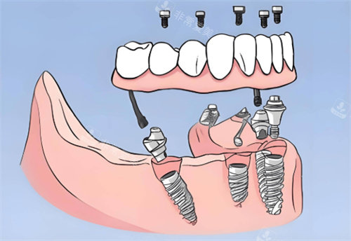 全口种植牙卡通图片