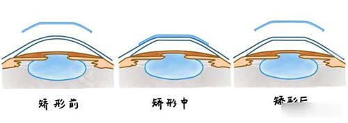 晶体植入矫正近视前中后漫画示意图