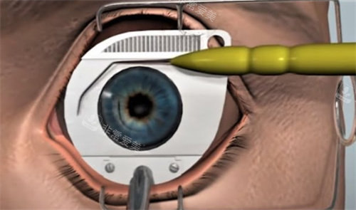 近视手术削角膜