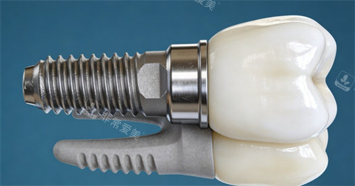牙齿种植改善照片展示