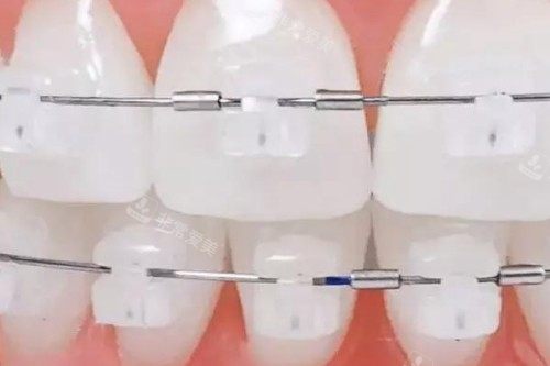 陶瓷半隐形矫正模型图