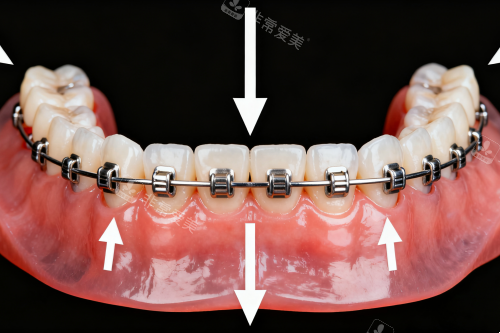 传统金属矫正器展示图