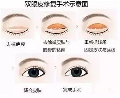 韩国整形术后多久能出门？不同项目有差异，术后出门时机及防护指南全解析